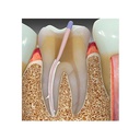 Cemento Biocerámico Bioceramic KP Root SP Woodpecker