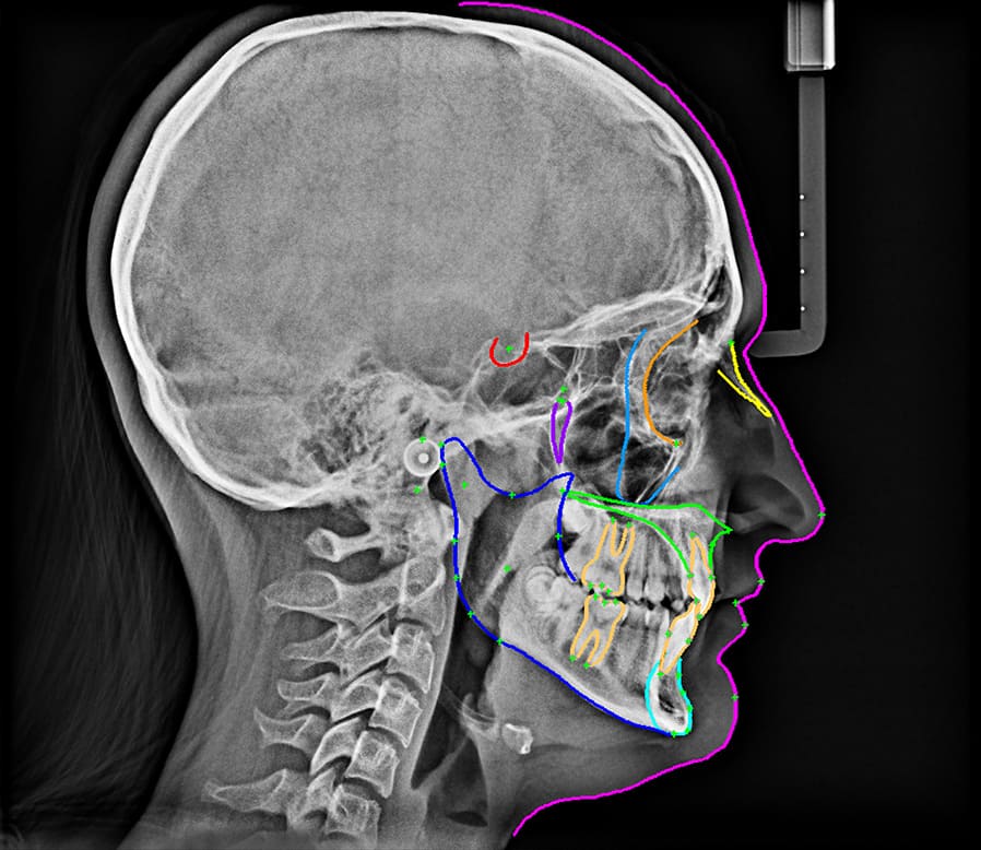 Equipo de Rayos x Panorámico + Cefalométrico Trophypan Smart 2D Trophy