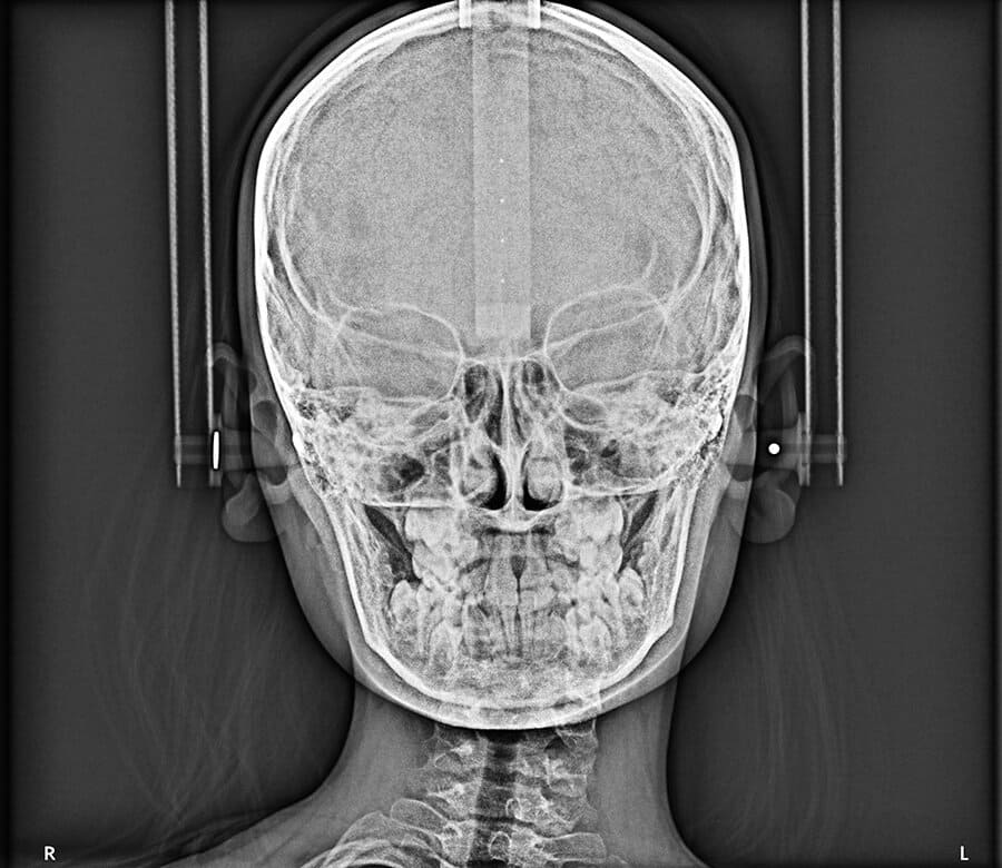 Equipo de Rayos x Panorámico + Cefalométrico Trophypan Smart 2D Trophy