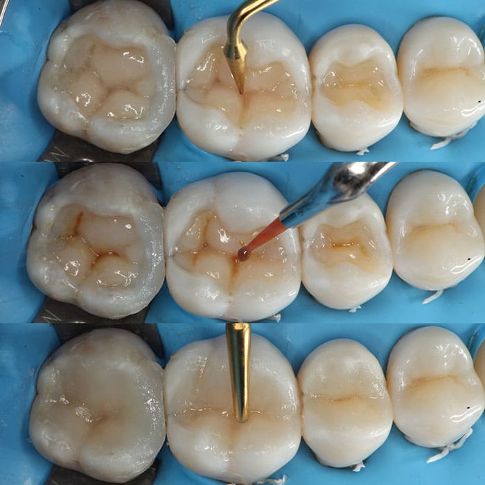 Kit Maquillaje para Resina Composite Estelite Color Tokuyama