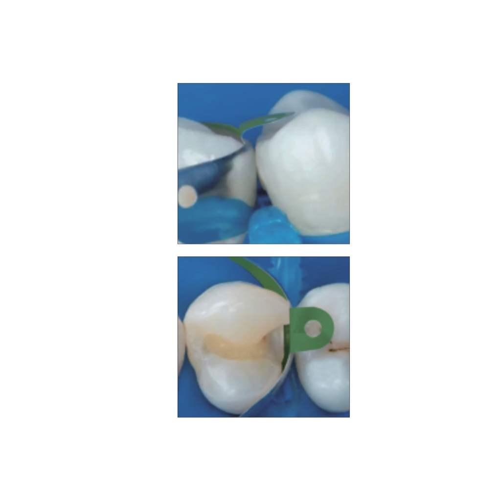 Set de 50 Bandas Matriz preformada acero antiadherente Matrix M4 2.0 ZT Dental