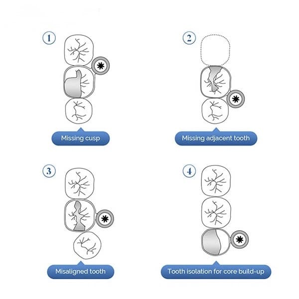 Set de 50 Bandas Matriz acero con ajuste M6 tipo Kerr 0,038 mm ZT Dental