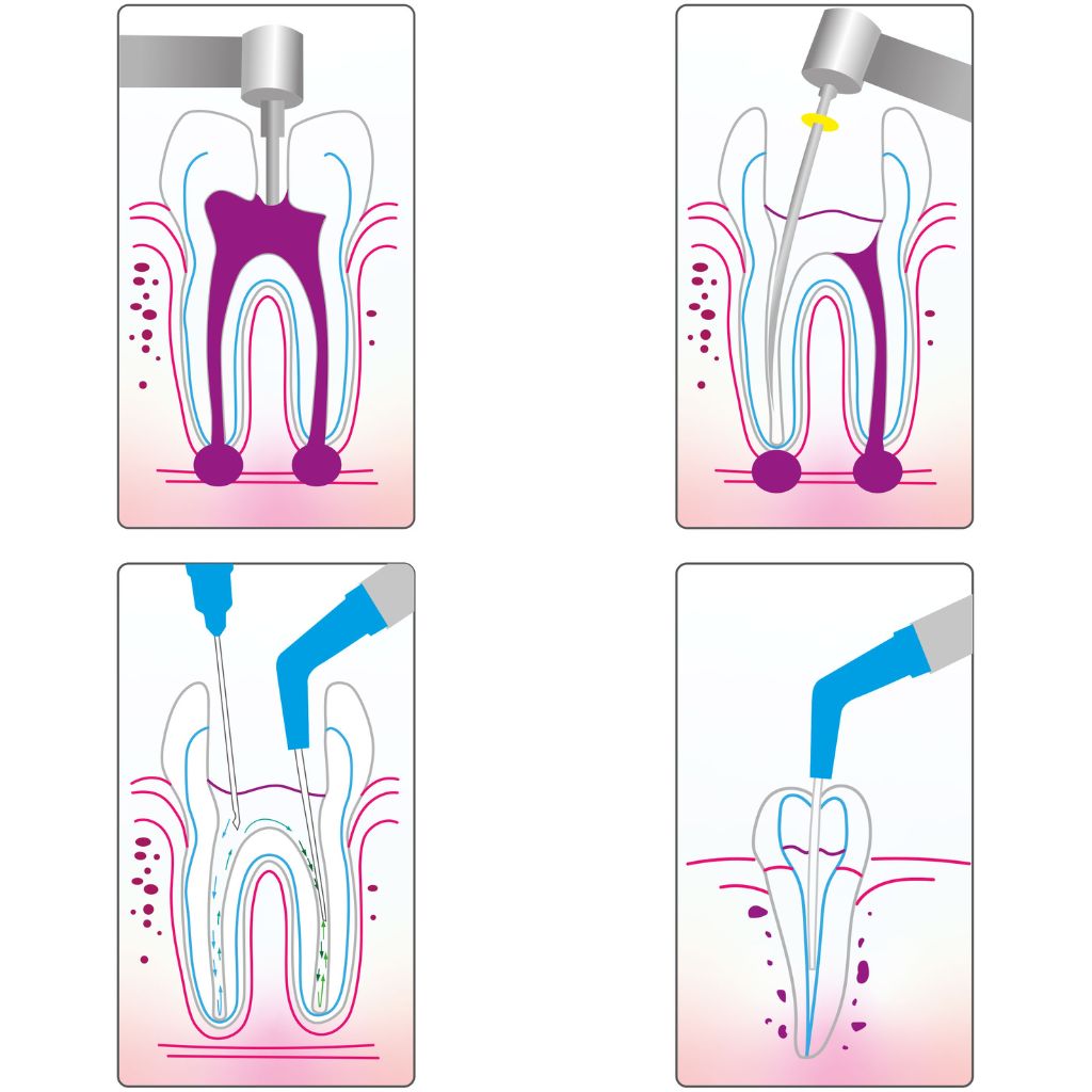 Cánulas para Aspiración para Endodoncia Cotisen