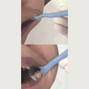 Espejo Doble intraoral con mango Autoclavable Ehros