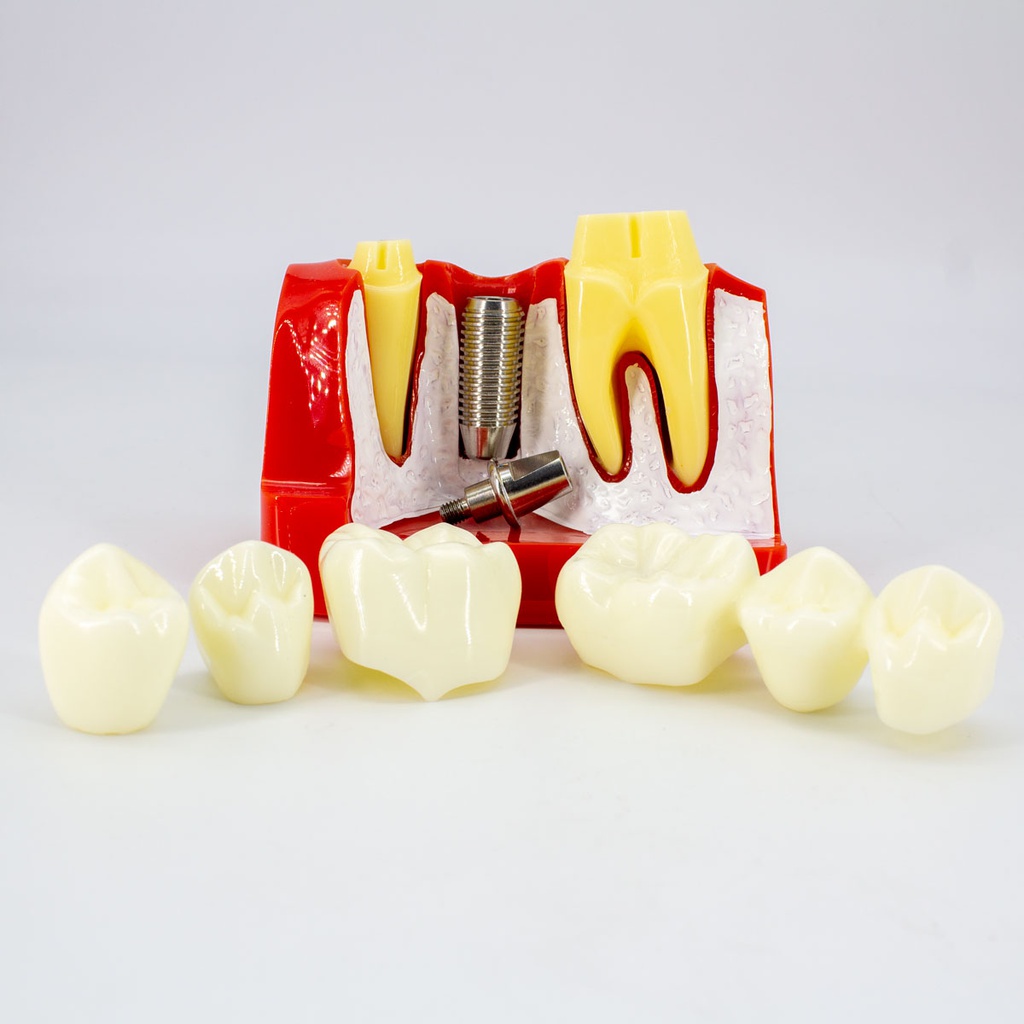 Macromodelo Implante y Corona M2017 Machtig