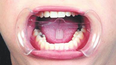 Separador Labial/Abreboca con Retractor Lingual Machtig