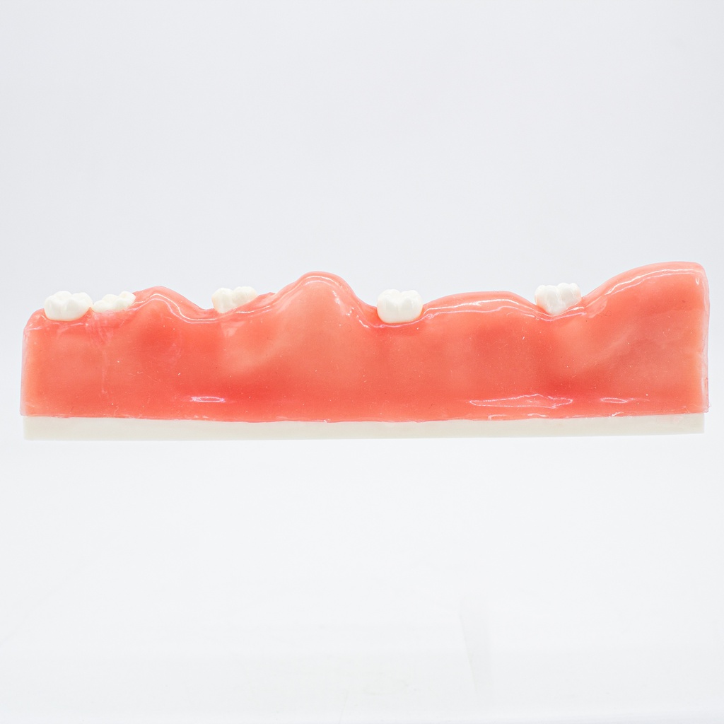 Modelo estudio Extracción de dientes impactados Machtig